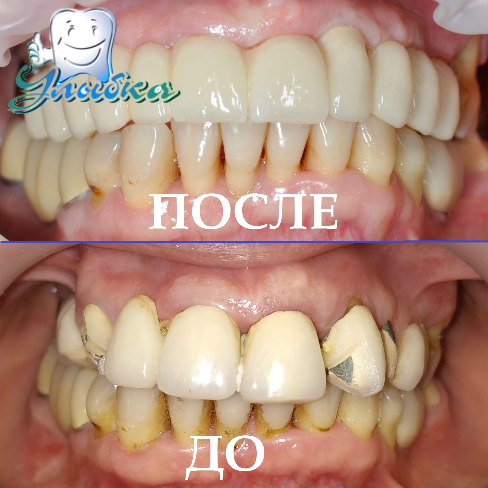 имплантация зубов в Подольске. Имплант. Коронки